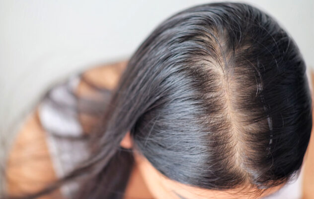 โรคผมบางทางพันธุกรรม